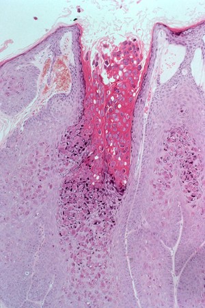 view Molluscum contagiosum