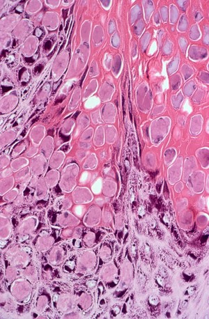 view Molluscum contagiosum