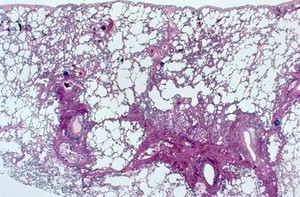view Lung: Kaposi's sarcoma and HIV