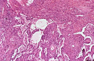 view Lung: Kaposi's sarcoma