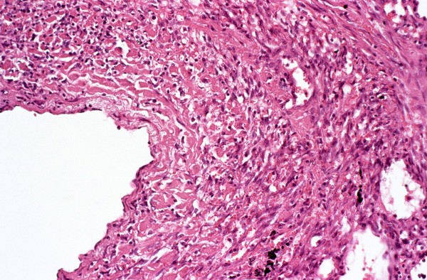 Lung: Kaposi's sarcoma