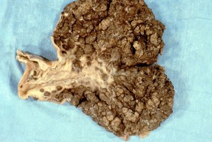 view Stomach: Kaposi's sarcoma