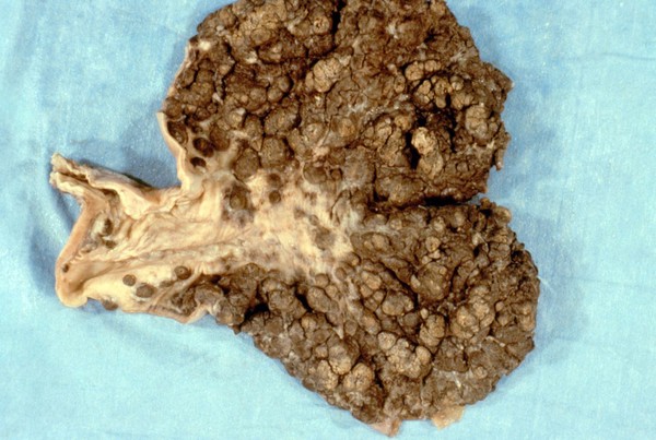 Stomach: Kaposi's sarcoma