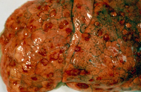 Lung: Kaposi's sarcoma