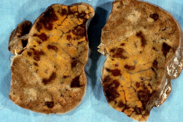 Lung: Kaposi's sarcoma