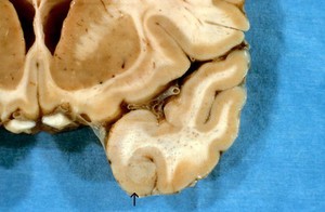 view Nocardiosis: intracranial abscess