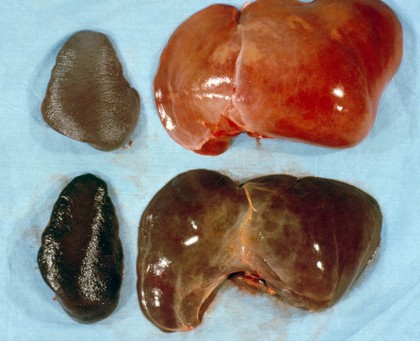 <I>Plasmodium falciparum</I> malaria: liver and spleen