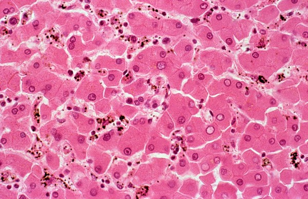 <I>Plasmodium falciparum</I> malaria: liver