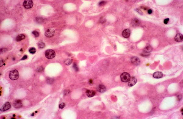 <I>Plasmodium falciparum</I> malaria: liver