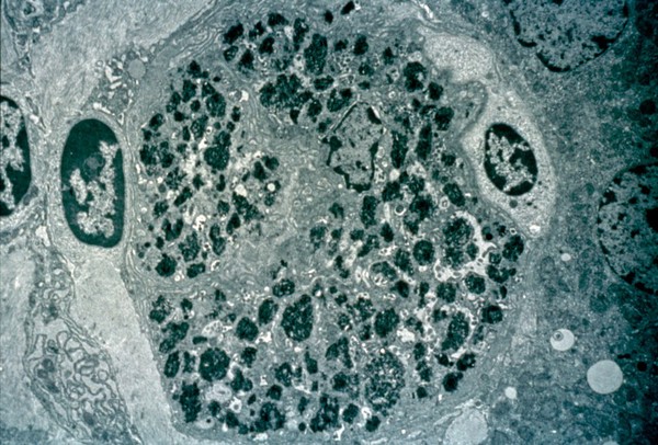 <I>Plasmodium falciparum</I> malaria: liver