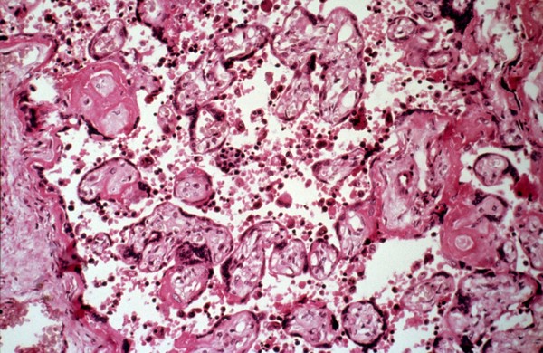 <I>Plasmodium falciparum</I> malaria: placenta