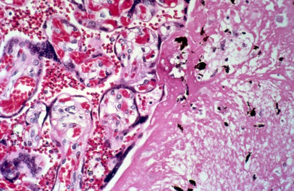 <I>Plasmodium falciparum</I> malaria: placenta