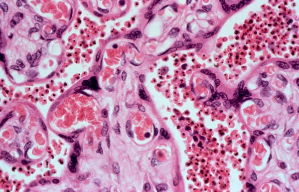 <I>Plasmodium falciparum</I> malaria: placenta