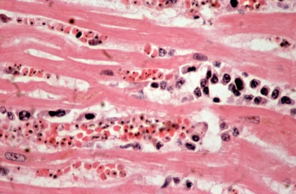 <I>Plasmodium falciparum</I> malaria: heart