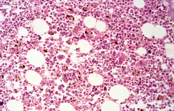 <I>Plasmodium falciparum</I> malaria: bone marrow