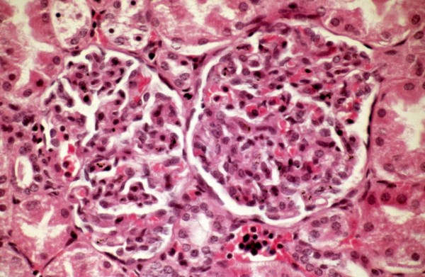 <I>Plasmodium falciparum</I> malaria: kidney