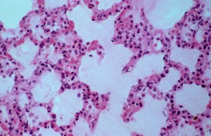 view <I>Plasmodium falciparum</I> malaria: lung