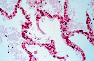 view <I>Plasmodium falciparum </I>malaria: lung