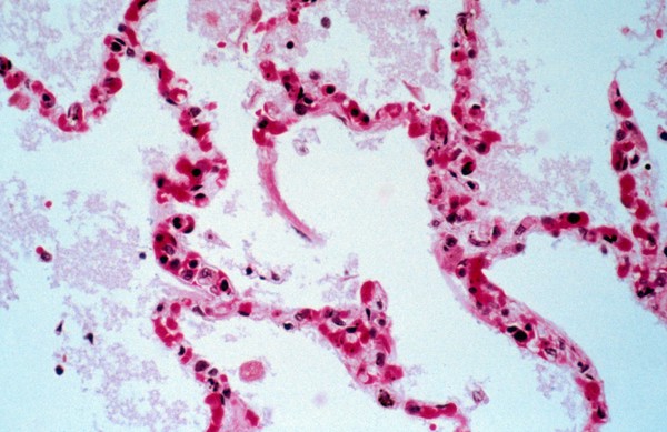 <I>Plasmodium falciparum </I>malaria: lung