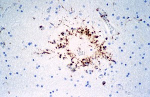 view <I>Plasmodium falciparum</I> malaria: cerebral malaria