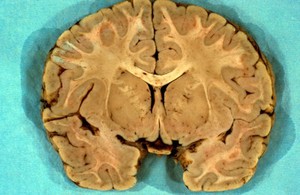 view <I>Plasmodium falciparum</I> malaria: cerebral malaria