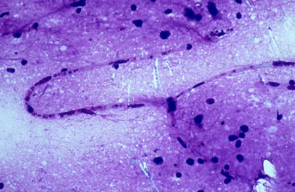 <I>Plasmodium falciparum</I> malaria: cerebral malaria