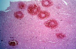 view <I>Plasmodium falciparum</I> malaria: cerebral malaria