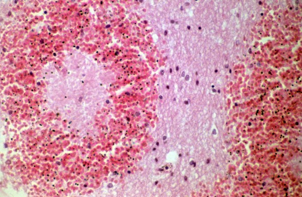 <I>Plasmodium falciparum</I> malaria: cerebral malaria