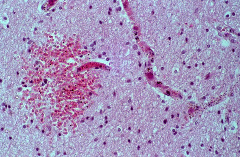 Plasmodium falciparum malaria: cerebral malaria | Wellcome