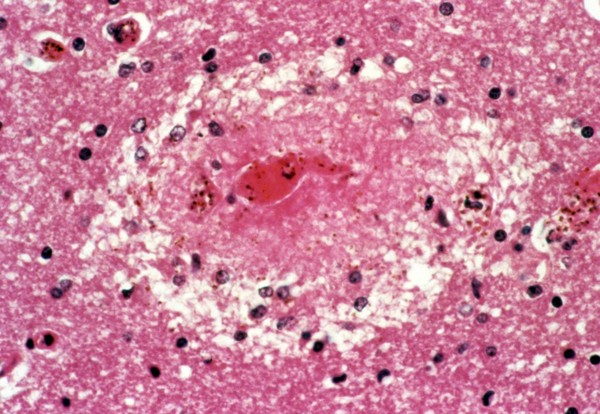 <I>Plasmodium falciparum</I> malaria: cerebral malaria