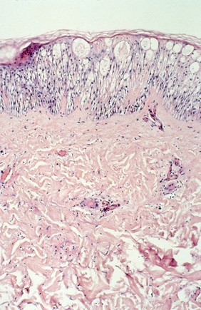 Skin: <i>Pseudomonas aeruginosa</i> vasculitis