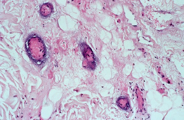 Skin: <i>Pseudomonas aeruginosa</i> vasculitis