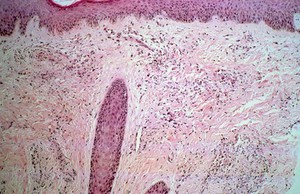 view Skin: disseminated histoplasmosis