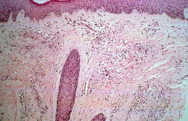 Skin: disseminated histoplasmosis