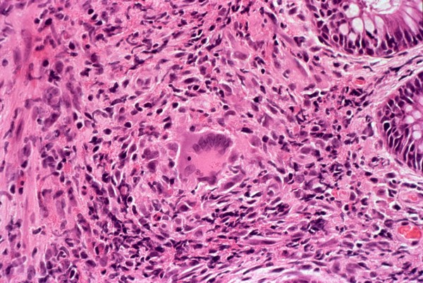 Schistosomiasis: histopathology of the large intestine