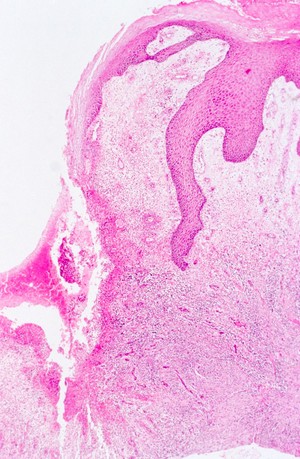 view Skin: cutaneous amoebiasis