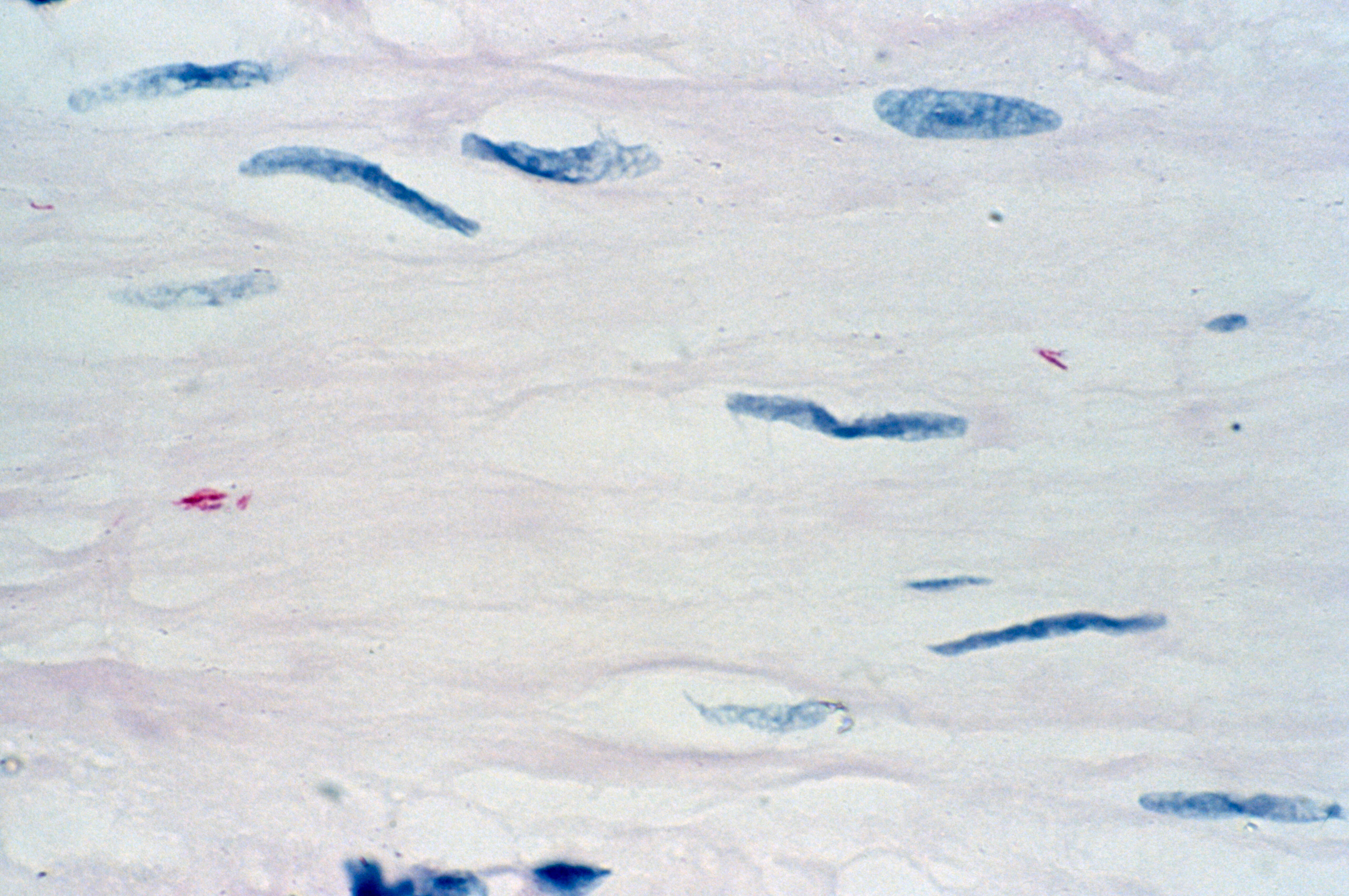 Leprosy Skin Biopsy Wellcome Collection