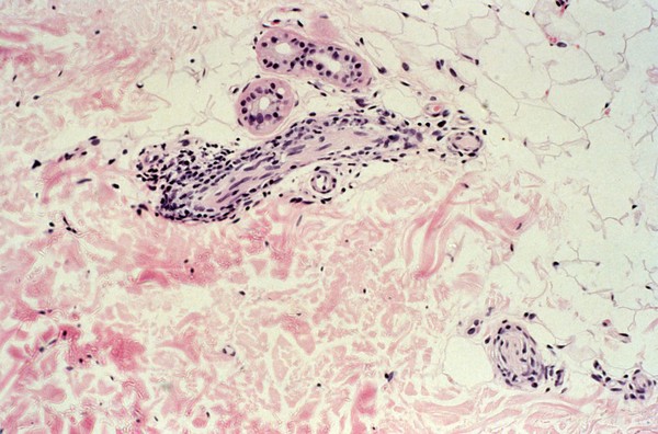 Leprosy: dermal nerve