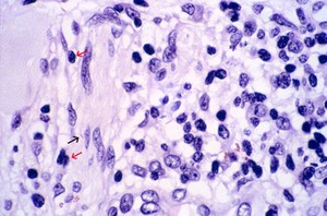 view Leprosy: dermal nerve