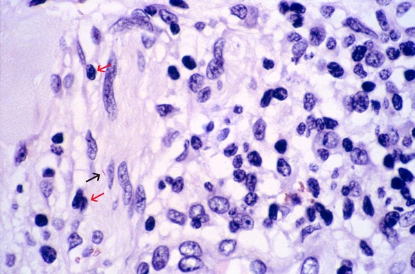 Leprosy: dermal nerve