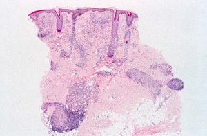 view Leprosy: histopathology of skin