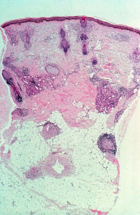 Leprosy: histopathology of skin