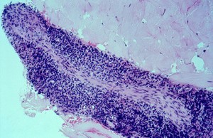 view Leprosy: dermal nerve