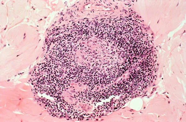 Leprosy: dermal nerve