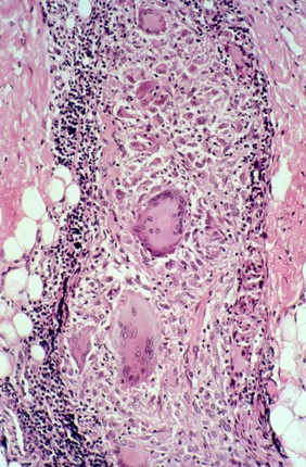 Leprosy: type 1 (reversal) leprosy reaction