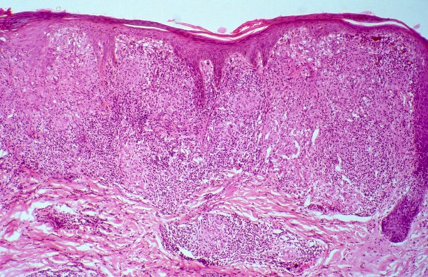 Leprosy: type 1 (reversal) leprosy reaction