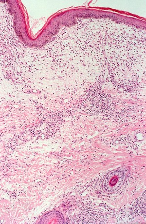 view Leprosy: type 1 (reversal) leprosy reaction