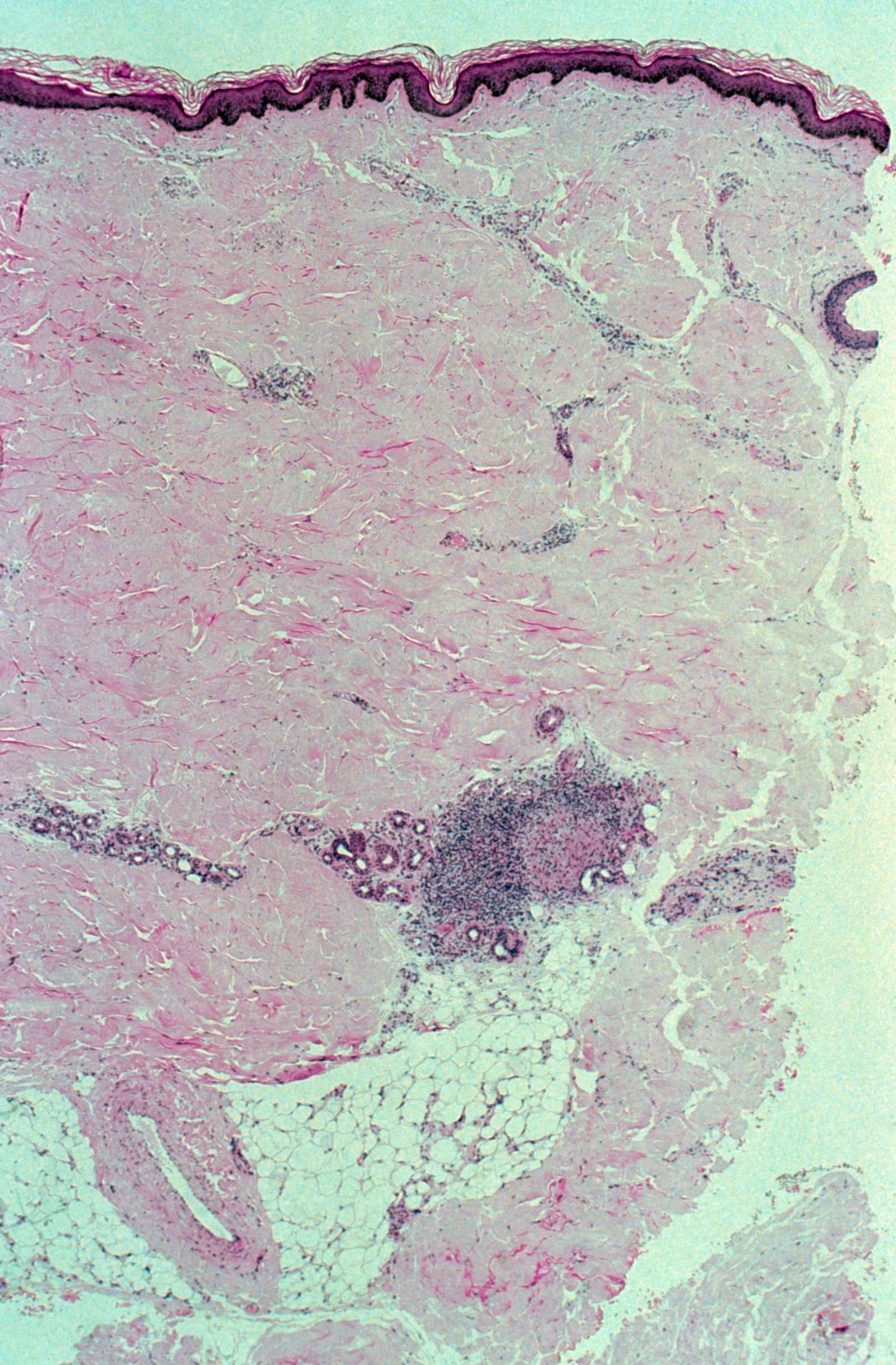 Leprosy Borderline Tuberculoid Leprosy Skin Wellcome Collection