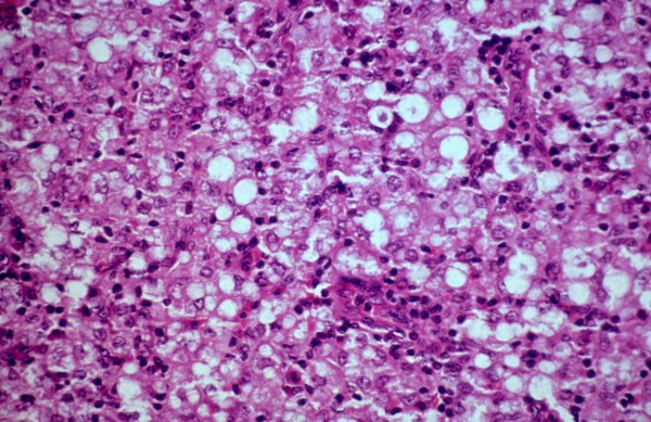 Lepromatous leprosy: lymph node