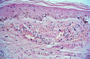 view Diffuse lepromatous leprosy: Lucio phenomenon